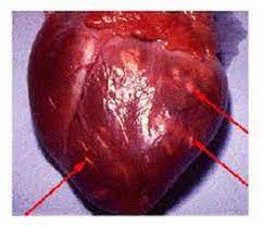 In altri, al superamento della fase di massima acuzie, può seguire un danno permanente con compromissione della funzione cardiaca e conseguente scompenso. La Miocardite