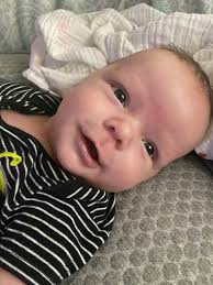 What to expect after craniosynostosis surgery?