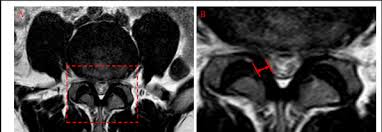A ligament (= strong fibre) that helps connect the bones that make up the spine 2. Measurement Of The Ligamentum Flavum Thickness By Mri A The Target Download Scientific Diagram
