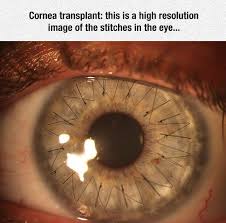 Eye Surgery Stitches Transplant Corneal Transplant Eyes