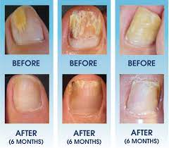 North York On Fungal Laser Treatment In Toronto
