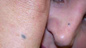 Image result for Blue Nevus