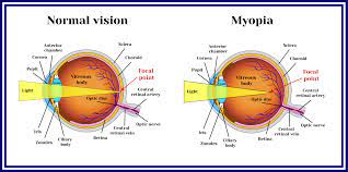 Artificial tears may be a good way to temporarily relieve eye dryness. Can Glasses Actually Make Your Vision Worse Nvision Eye Centers