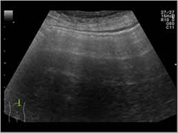 Ultrasounds use high frequency sound waves to create pictures of your fetus and reproductive organs (like your uterus and cervix). Abdomen And Retroperitoneum 1 6 Gastrointestinal Tract Case 1 6 5 Free Intraperitoneal Gas And Subcutaneous Emphysema Ultrasound Cases