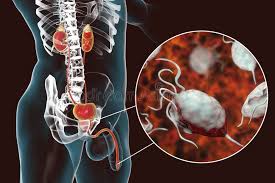 Infection trichomonas vaginalis solution naturelle