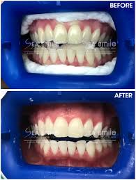Teeth whitening typically costs between $99 to $367 per session: Testimonials Sea Smile Dental Clinic