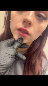 A beautiful before and after 1.1ml my signature technique