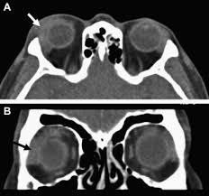 Image result for Dacryoadenitis