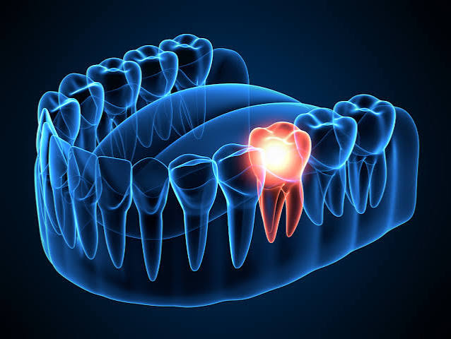 Emergency root canal New Brunswick