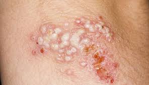 Hsv causes painful blisters or sores in different parts of the body. Herpes Simplex Virus 1 2 Clinical Advisor