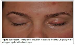 Doing internet research i have found information about a problem callled lagophthalmos. Complications Associated With The Surgical Techniques Of Upper Eyelid Loading A Clinicopathologic Study Of 7 Explanted Gold Weight Lid Loads Scitechnol