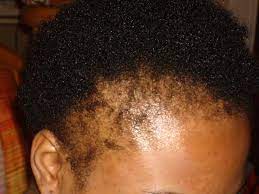 We did not find results for: Hair Loss In African American Women Dermhair Clinic 1 310 318 1500