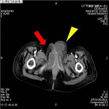 Image result for Bartholin's gland abscess