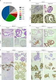 By ribbon color & cancer type. An Organoid Platform For Ovarian Cancer Captures Intra And Interpatient Heterogeneity Nature Medicine