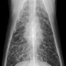 Primary lung tumors, which originate in the lung, are incredibly rare in cats. Lung Cat No 1 Diffuse Severe Bronchointerstitial Pattern Download Scientific Diagram