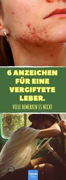 6 Anzeichen Fur Eine Vergiftete Leber Leber Vergiftung Akne Mudigkeit Lebergesundheit Detox Leberdetox Gesundheit Fettleber Leber Entgiften Hausmittel