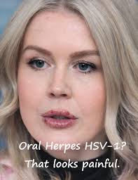 Oral Herpes HSV-1? That looks painful.