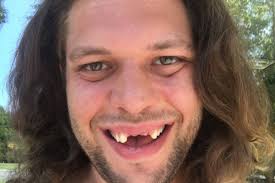 One in five people with learning disabilities in scotland aged 35 to 44 years has no teeth, a study has revealed.people with such disabilities are ten times more likely than other people of the same. Uvic Student S Christmas Wishlist Includes Three Front Teeth Saanich News