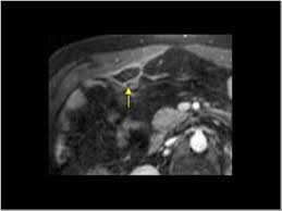 Modern living room tables images and appendices epiploicae symptoms. Abdomen And Retroperitoneum 1 7 Peritoneum Mesentery And Omentum Case 1 7 1 Appendagitis Epiploica And Mesenteric Infarct Ultrasound Cases