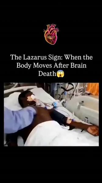 Declared dead… then suddenly alive again? Lazarus syndrome is the rare  phenomenon where a person's heart spontaneously starts beating after failed  CPR. It's rare, mysterious, and a reminder that medicine still has