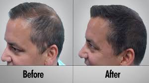 Hairmd has 28 years of clinical experience offering hair loss treatments with the latest fda approved if you suffer from chronic hair loss and none of the noninvasive treatments is working for you then you can go for surgical hair loss treatment for men. Men S Hair Loss Treatments And Solutions Hair Loss Cures
