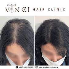 In many men by the age of 35, almost 40% have a very noticeable hair loss. Signs Of Hair Loss In Women And How To Get Help Vinci Hair Clinic