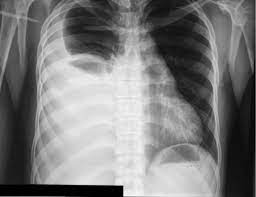 21.09.2017 · the symptoms of pleural effusion include: Initial Chest X Ray Demonstrated A Large Right Pleural Effusion That Download Scientific Diagram