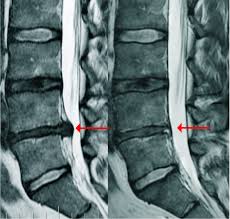 Image result for vyhřezlá ploténka