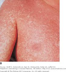 Jun 02, 2016 · an amoxicillin rash by itself isn't dangerous if your child doesn't have an allergy to the medication. Pathophysiology And Clinical Presentation Correct Diagnosis Infectious Mononucleosis Im