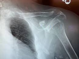 Milwaukee shoulder syndrome is a severe destructive arthritis of the glenohumeral joint with loss of the rotator cuff associated with the presence of bcp crystals. Robby Bowers Do Phd On Twitter Diagnosed A Patient With Milwaukee Shoulder Syndrome Today Definitely A First For Me Drained 180 Cc S From The Glenohumeral Joint Https T Co Upqo47qsvv Orthopedics Shoulder Milwaukeeshoulder
