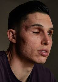 Suicide attempt to professional baseball