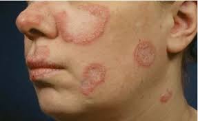 Therapeutic Action Research of Bacille Calmette Guerin (BCG)