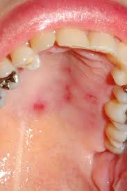 Image result for Oral herpes roof of mouth