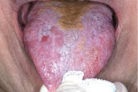 Image result for lichen planus on tongue)