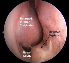 See more ideas about nasal septum, septum, sinusitis. Deviated Nasal Septum Sinus Care Henry Ford Health System Detroit Mi