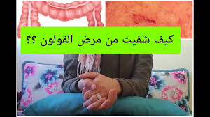 تجربتي مع القولون التقرحي أعراضه و تشخيصه بكل التفاصيل الشفاء منه حلم أم حقيقة Youtube