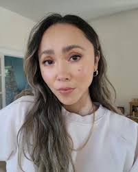 17 Famous People with Vitiligo