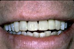 Green tea the antioxidants in green tea help to strengthen teeth and gum tissue. Stabilization Of Loose Teeth Cherry Hill Nj How To Treat Loose Teeth