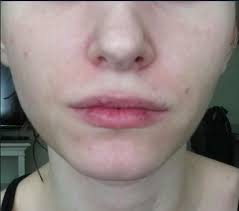 Permanent Redness Around Mouth Sides Of Nose 10 Years W Pics Page 2 Redness Nose Perioral Dermatitis