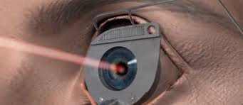 Intentionez sa fac o operatie cu laser pt corectarea miopiei.poate cineva sa imi dea un sfat? Se Poate Trata Astigmatismul Cu Operatie Laser Ziarul Nationalul