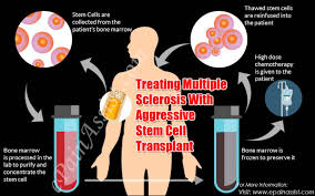 Multiple sclerosis (ms), also known as encephalomyelitis disseminata, is a demyelinating disease in which the insulating covers of nerve cells in the brain and spinal cord are damaged. Ø£ÙØ¶Ù„ Ø²Ø±Ø¹ Ø§Ù„Ø®Ù„Ø§ÙŠØ§ Ø§Ù„Ø¬Ø°Ø¹ÙŠØ© Ø§Ù„Ù…ÙƒÙˆÙ†Ø© Ù„Ù„Ø¯Ù… Ù„Ù…Ø±Ø¶ Ø§Ù„ØªØµÙ„Ø¨ Ø§Ù„Ù…ØªØ¹Ø¯Ø¯ ÙÙŠ Ø§Ù„Ù‡Ù†Ø¯