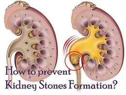 How To Avoid Formation Of Kidney Stones Problems Si Te Shmangim Problemet Me Guret Ne Veshka Family Blog Cherry Tea Hydration Challenge Kidney Stones