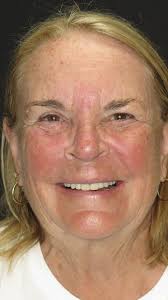 Karen had both upper and lower crowns done with us! Recieve your dream  smile with us today!