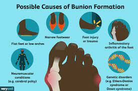 We did not find results for: Bunions Symptoms Causes Diagnosis And Treatment
