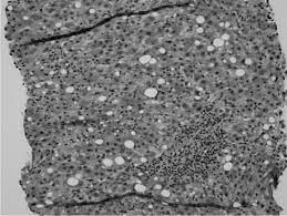 Fluoxetine Induced Stevens Johnson Syndrome And Liver Injury Agrawal 2019 Journal Of Clinical Pharmacy And Therapeutics Wiley Online Library