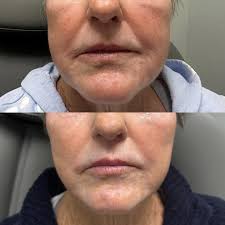 ✨ Facial Balancing with Filler: What You Need to Know ✨ Facial balancing is  all about enhancing your natural features to create a more harmonious look.  With dermal fillers, we can subtly