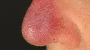 It is pathognomonic of sarcoidosis.:701 the name lupus pernio is a misnomer. Lupus Pernio Altmeyers Encyclopedia Department Dermatology