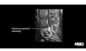 Image result for Spinal Infection