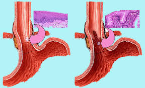 Image result for esophagus