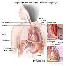 Esophageal cancer is cancer that occurs in the esophagus — a long, hollow tube that runs from your throat to your stomach. Esophageal Cancer Treatment Adult Pdq Patient Version National Cancer Institute